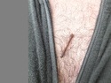 Leech on my chest